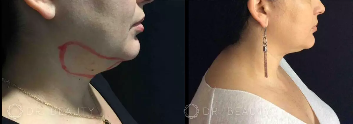 CoolSculpting® Before and After Results