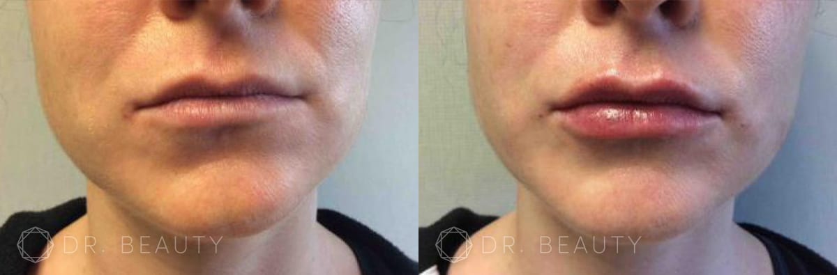 Dermal Fillers Results Detroit