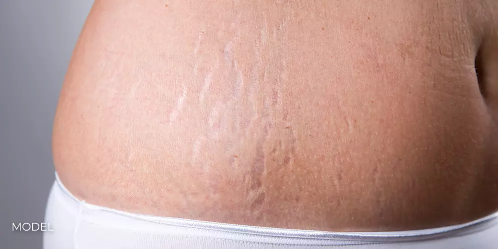 Laser Scar Revision Southfield, Michigan